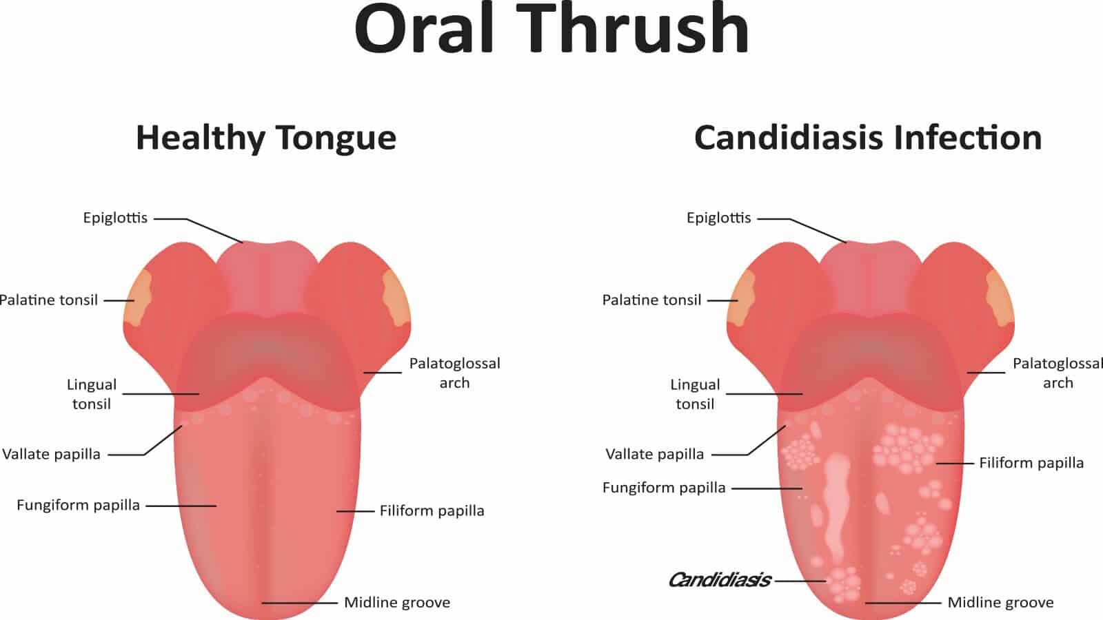 oral candidiasis 5