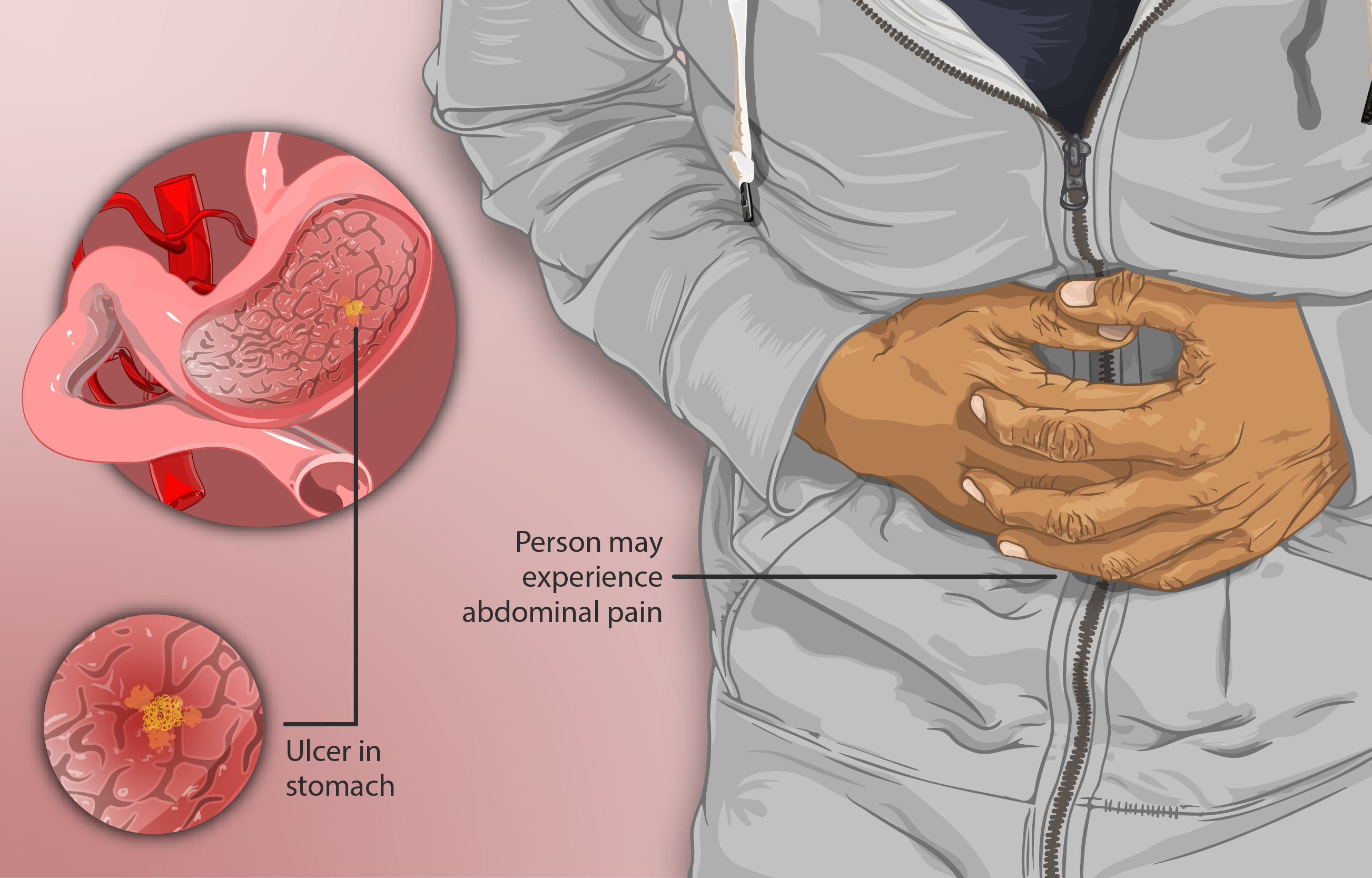 Depiction of a patient suffering from peptic ulcers