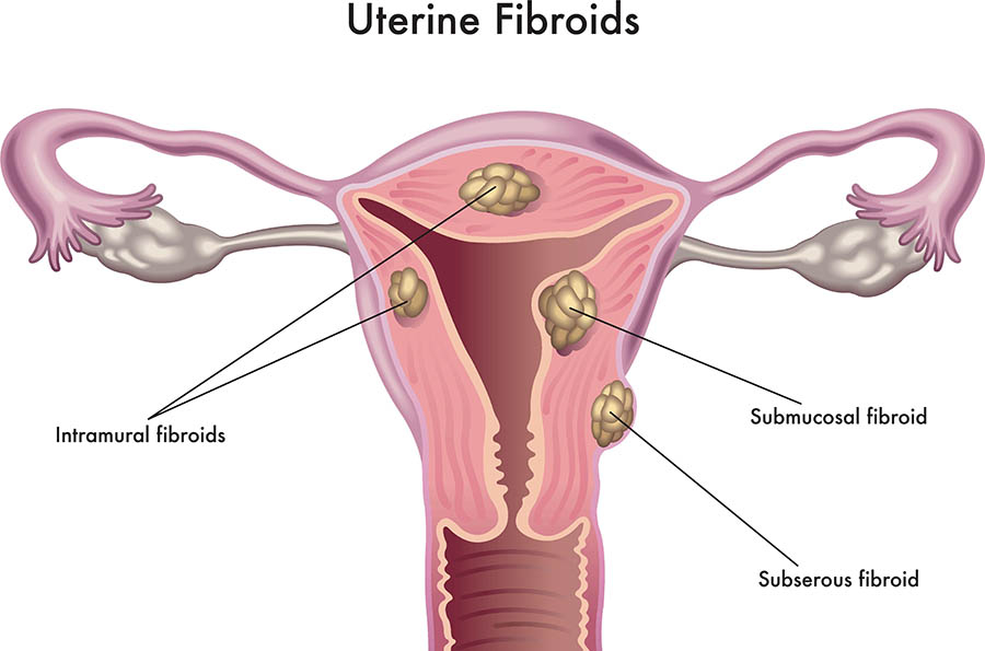 fibroids illustration f9f71b