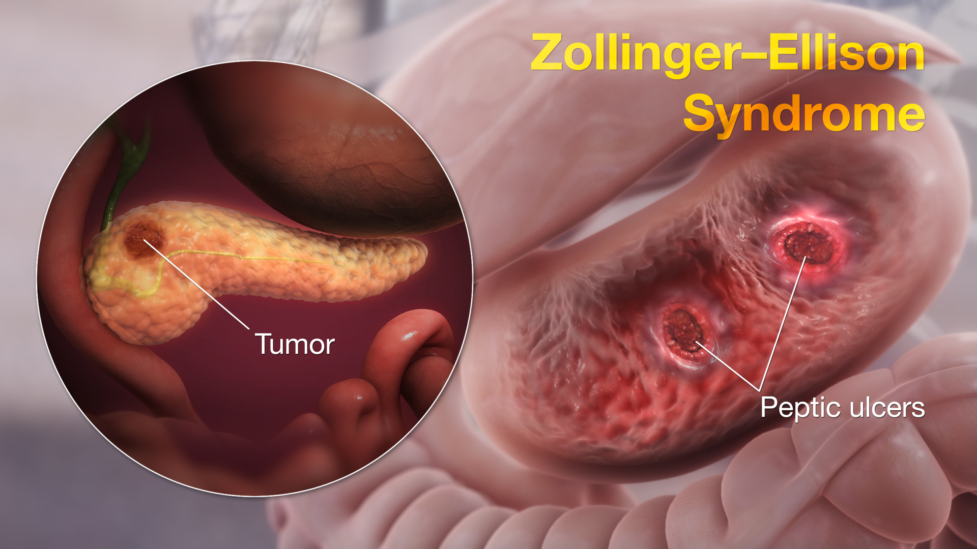 Zollinger Ellison Syndrome shown using medical animation still shot