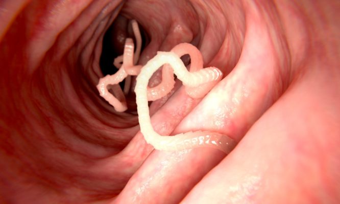 tapeworm in human intestine picture id698658302 666x399