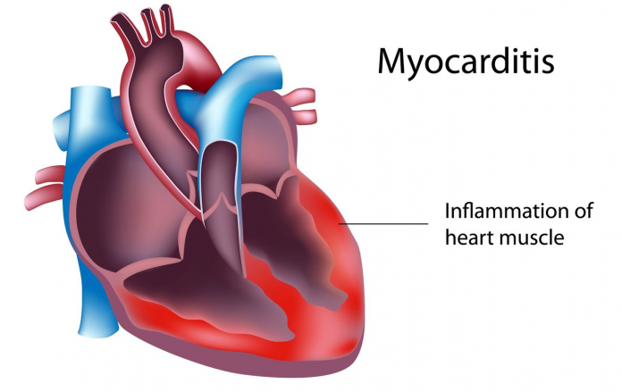 myocarditis 1