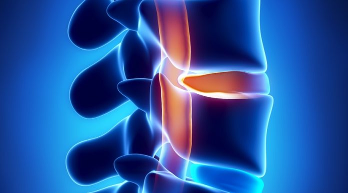 images_disc-herniation1