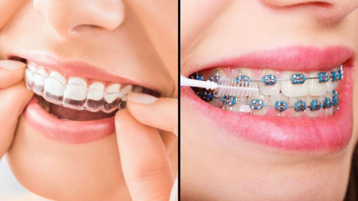 Oρθοδοντική με τη μέθοδο INVISALIGN