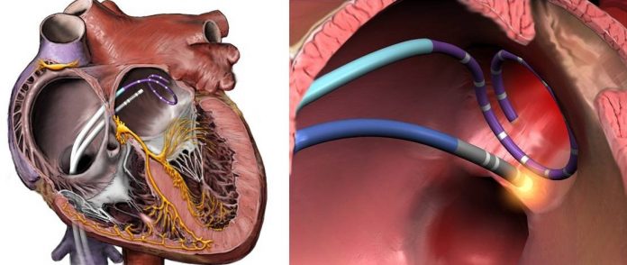 images_atrial-fibrillation-ablation-technique