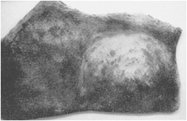 Μαστεκτομή, 3ος αιώνας π.Χ., Λείπει ο δεξιός μαστός και στη θέση του μοιάζει να έχει μείνει ένα μεγάλο έλκος. Πρόκειται άραγε για μαστεκτομή που δεν μπορεί να επουλωθεί το έλκος;             