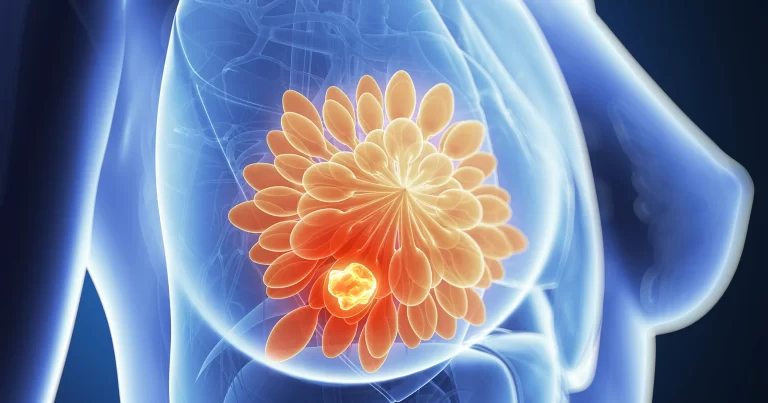 Η ορμονοθεραπεία στον καρκίνο του μαστού