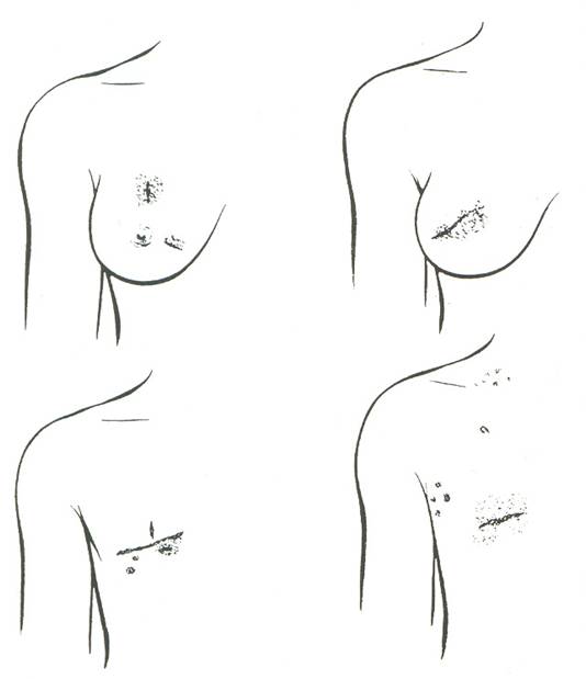 4 παραδείγματα από τον C. H. Moore (1867) που δείχνουν τοπική υποτροπή μετά από μη επαρκή εγχείρηση