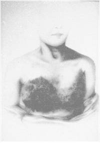 Μια από τις περιπτώσεις του Theodor Billorth στην Ζυρίχη, 1860-67