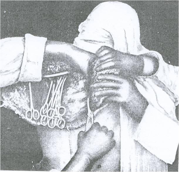 WillyMeyer’s αυθεντική εικόνα που δείχνει την τεχνική που ακολουθούσε στο τελικό στάδιο της επέμβασης   Πρόκειται για την πρώτη φωτογραφική απεικόνιση εγχειρήσεως  (From Meyer W.: Medical Record. 46:746. 1894)