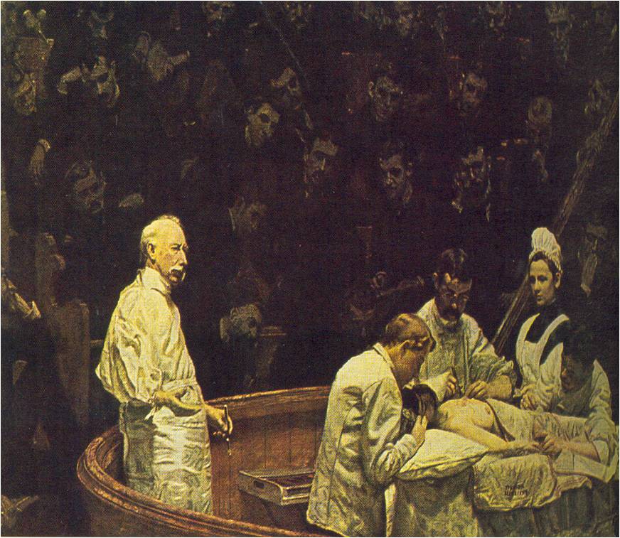 Μαστεκτομή.  The portrait of Danid Hayes Agnew,1889, by Thomas Eakins.  Χρησιμοποιούνται αποστειρωμένα εργαλεία, αλλά όχι χειρουργικά γάντια