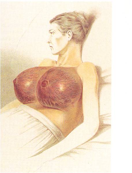 Διπλή καρκινωματώδης διάχυτος διήθηση αμφότερων των μαστών  «Εγχειρητική» Ευάγγελου Καλιοντζή, έκδοση από την Εστία 1899  Από το βιβλίο: Die Krankheiten der Brustdrüsen, 1880 του  Th. Billroth