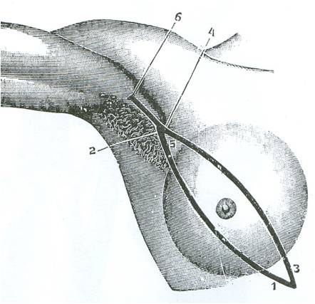 Α): Μηνοειδείς τομές (1,2,3,5) για αφαίρεση του μαστού, με επέκταση αυτών στην μασχάλη (4, 6) «Εγχειρητική» Ευάγγελου Καλιοντζή, έκδοση από την Εστία 1899