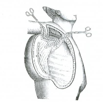 Αφαίρεση του μαστού (1-1) και των σύστοιχων μασχαλιαίων λεμφαδένων (2-2) «Εγχειρητική» Ευάγγελου Καλιοντζή, έκδοση από την Εστία 1899