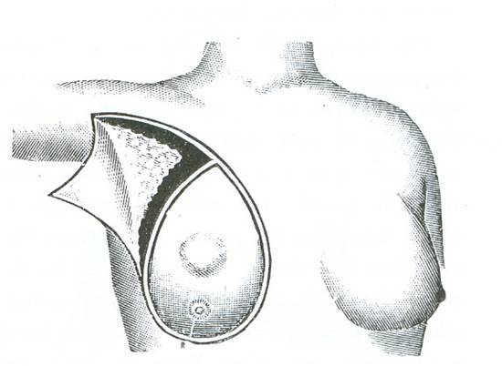 Τομή κατά Halsted για αφαίρεση του μαστού και υποδορά μασχαλιαίου δερματικού κρημνού για αφαίρεση των σύστοιχων μασχαλιαίων γαγγλίων  «Εγχειρητική» Ευάγγελου Καλιοντζή, έκδοση από την Εστία 1899