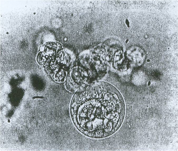 Χρώση καρκινικού κυττάρου μαστού