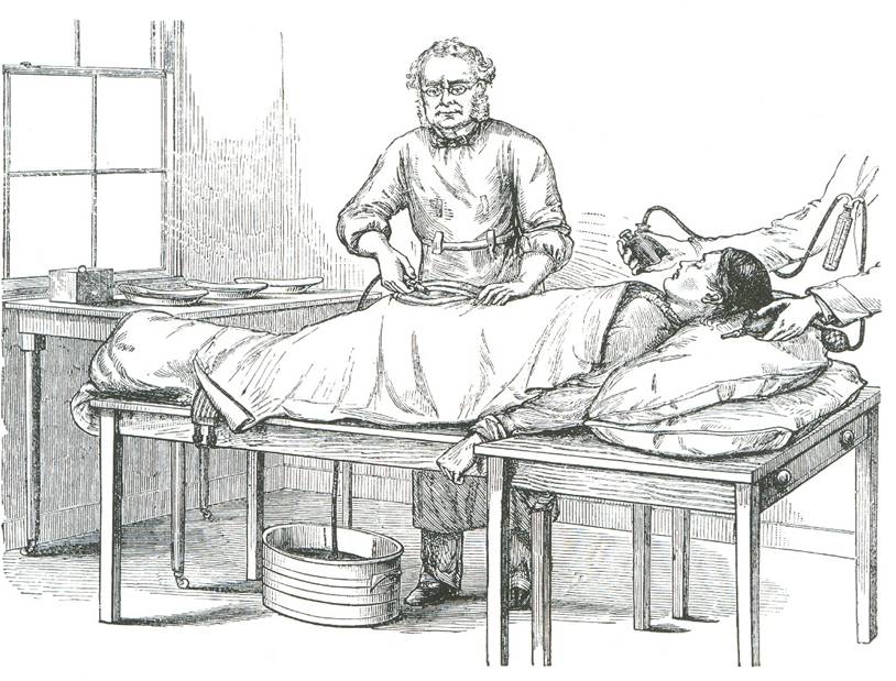Ωοθηκεκτομή, «Abdominal tumors» (1865), T. S. Well