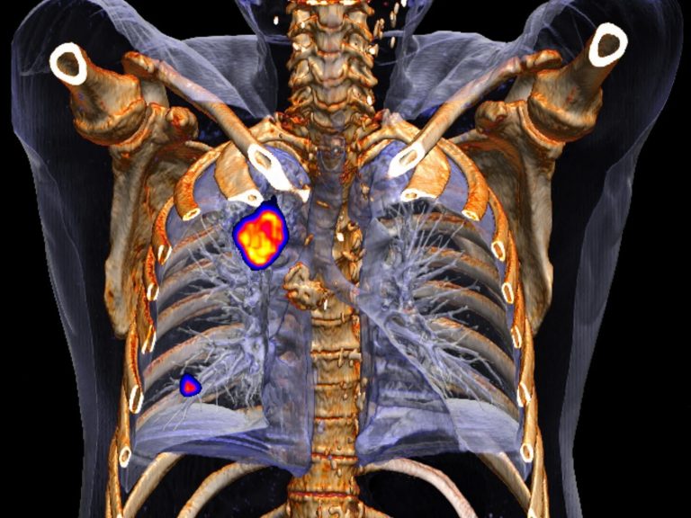 Θεραπεία πρώιμου καρκίνου του πνεύμονα χωρίς χειρουργείο