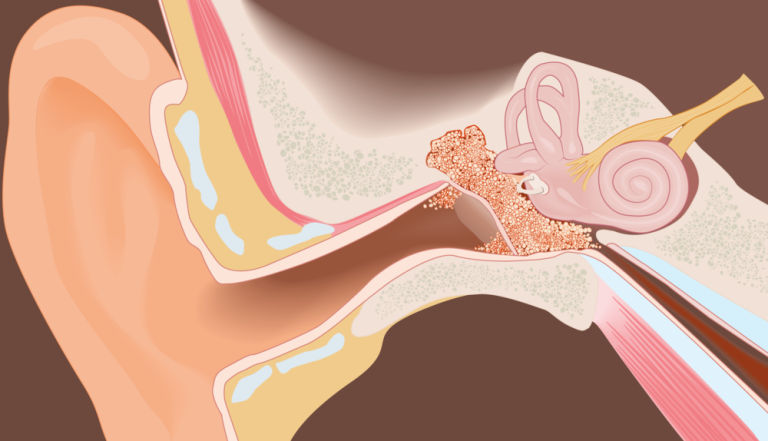 Χολοστεάτωμα