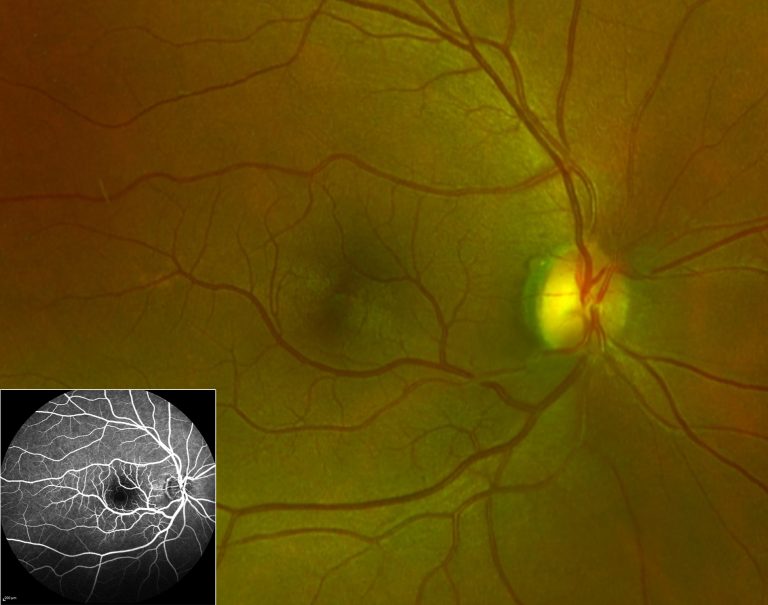 Τι είναι η φλουοροαγγειογραφία