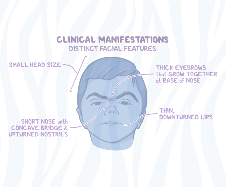 Σύνδρομο Cornelia de Lange