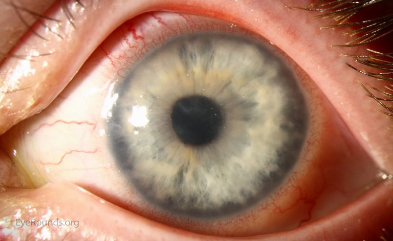 Μη φοράτε φακούς επαφής στην πισίνα