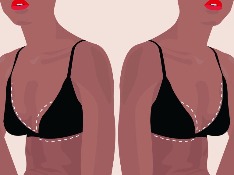 Χειρουργική μείωση μαστών