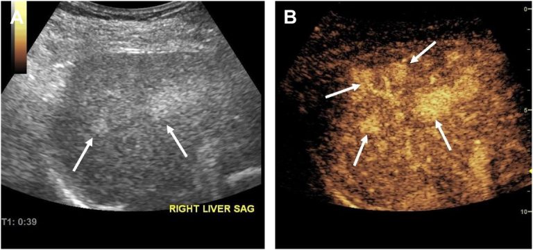 Υπέρηχος με χρήση σκιαγραφικού