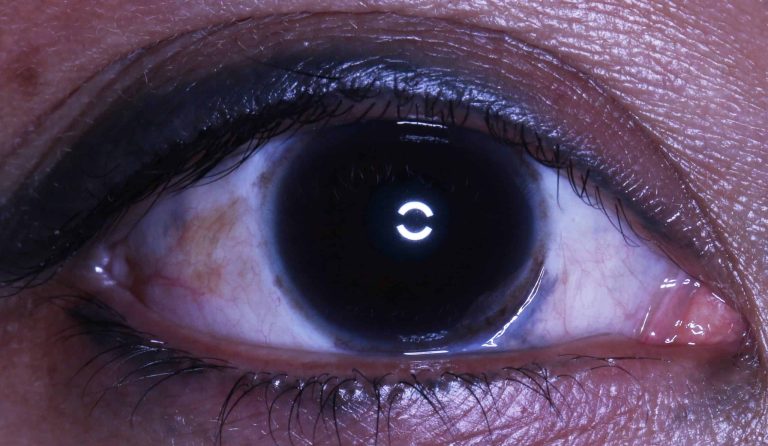 Σπίλος του ota