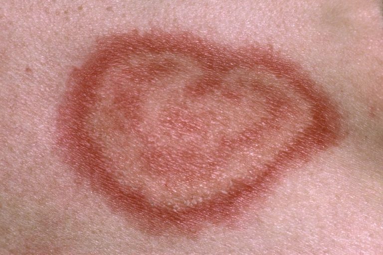 Ο δισκοειδής ερυθηματώδης λύκος