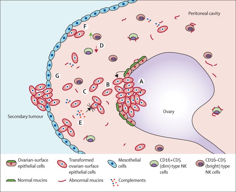 Βλεννώδες κυσταδενοκαρκίνωμα των ωοθηκών