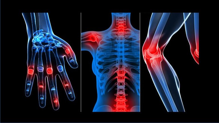 Όζοι σε ρευματολογικές παθήσεις