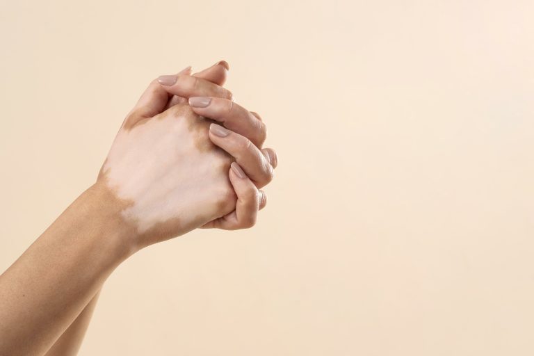 Οι απαραίτητες βιταμίνες για τη λεύκη