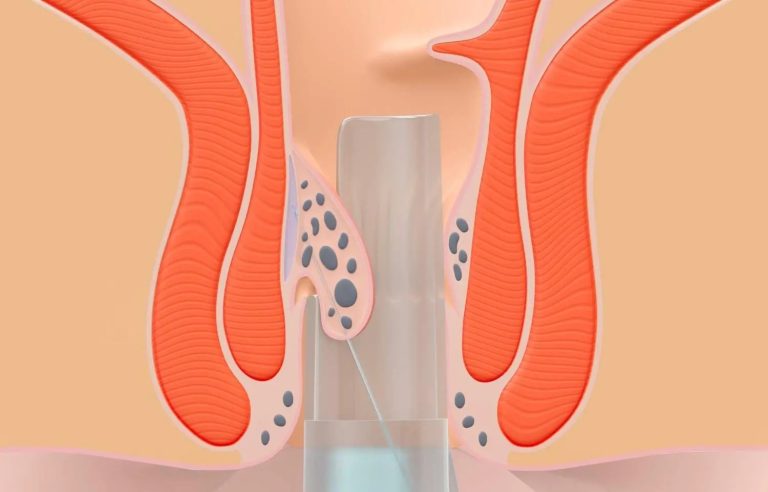 Οι αιμορροΐδες