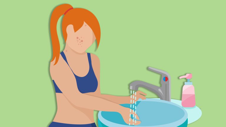 Διατροφή για την ακμή