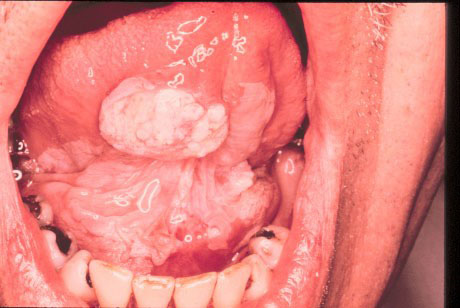 Λευκοπλακία στόματος