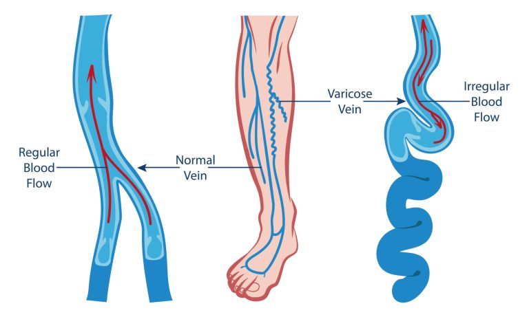 Οι απαραίτητες βιταμίνες για τη φλεβίτιδα