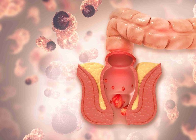 Θεραπεία αιμορροΐδων με υπερήχους