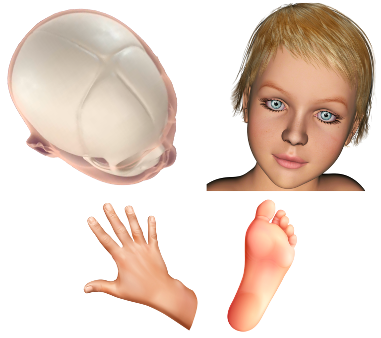 Το σύνδρομο Apert