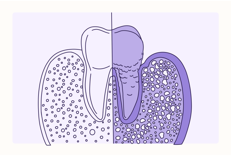 Οι καλύτερες βιταμίνες για την ουλίτιδα