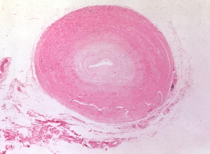 Αρτηρίτιδα Takayasu