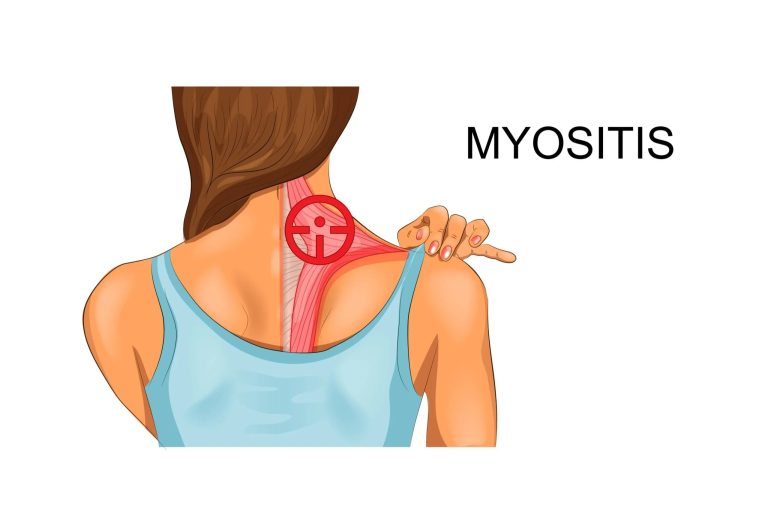 Η μυοσίτιδα