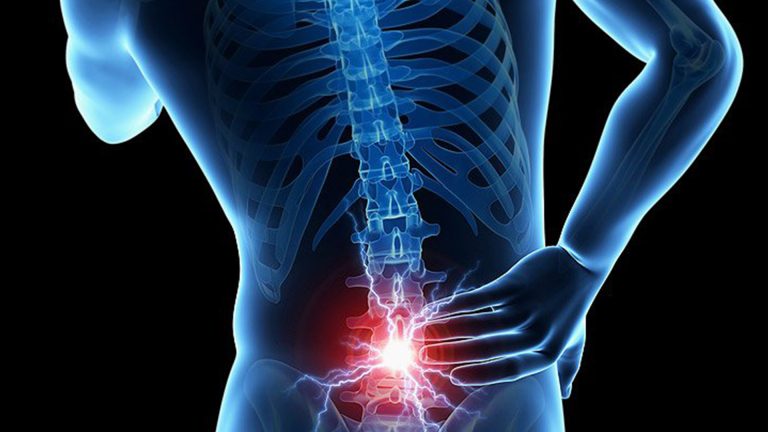 Λαπαροσκοπική σπονδυλοδεσία από Έλληνες γιατρούς