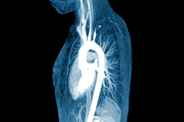 Αρτηρίτιδα Takayasu