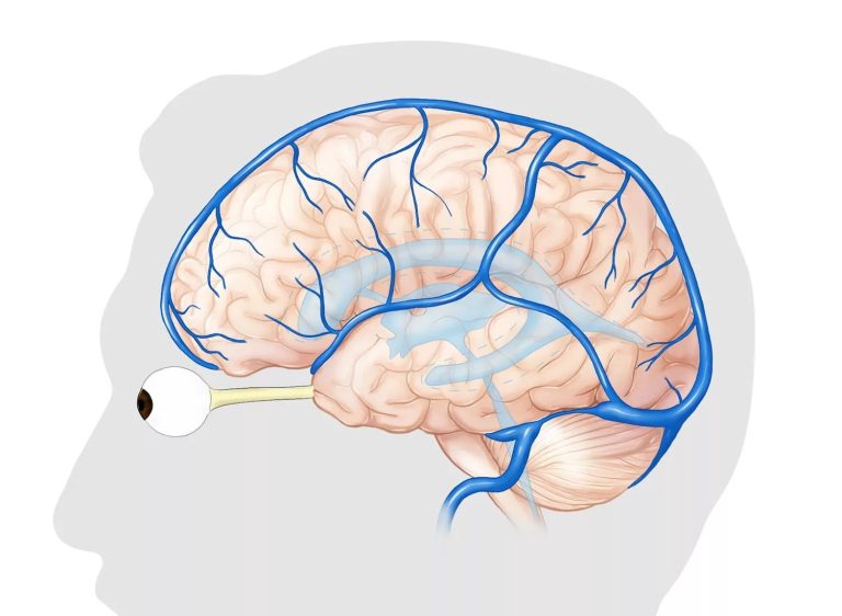 Ψευδοόγκος εγκεφάλου
