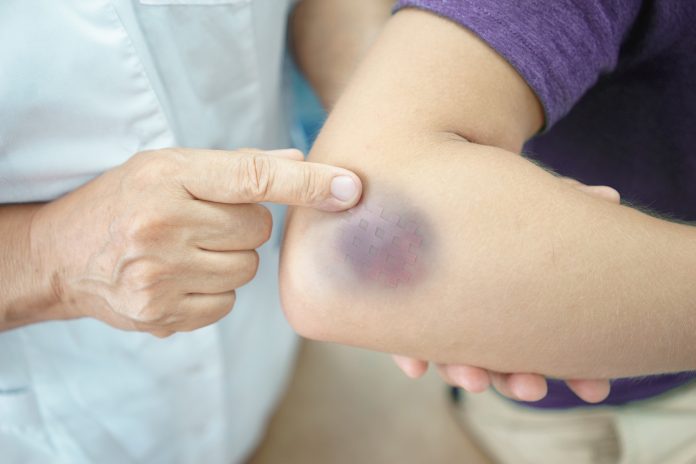 bruises-2