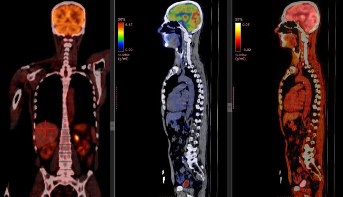 PET-CT-2