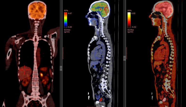 Πρώιμη διάγνωση καρκίνου με PET-CT
