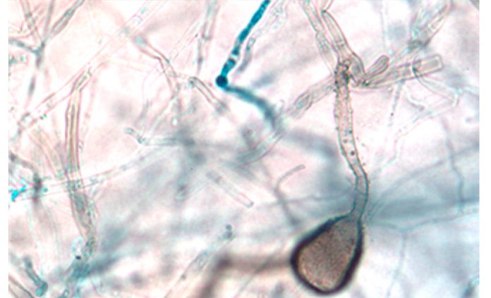 Chromoblastomycosis-2
