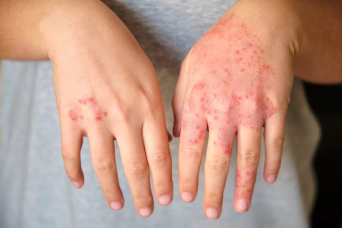 Hand-Eczema-1